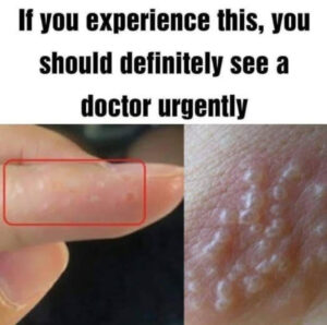 If You Notice Painful Red Bumps, You Might Have Dyshidrotic Eczema