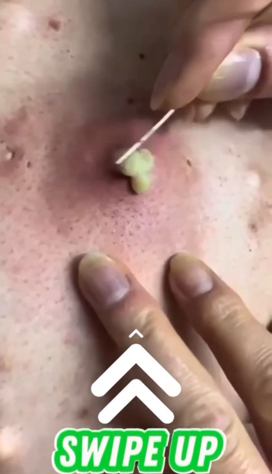 When to See a Dermatologist for Acne: A Guide to Cysts, Nodules, and Persistent Acne