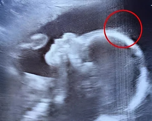 A Baby Born with a Head Full of Hair: How One Little Girl Captured Hearts Around the World