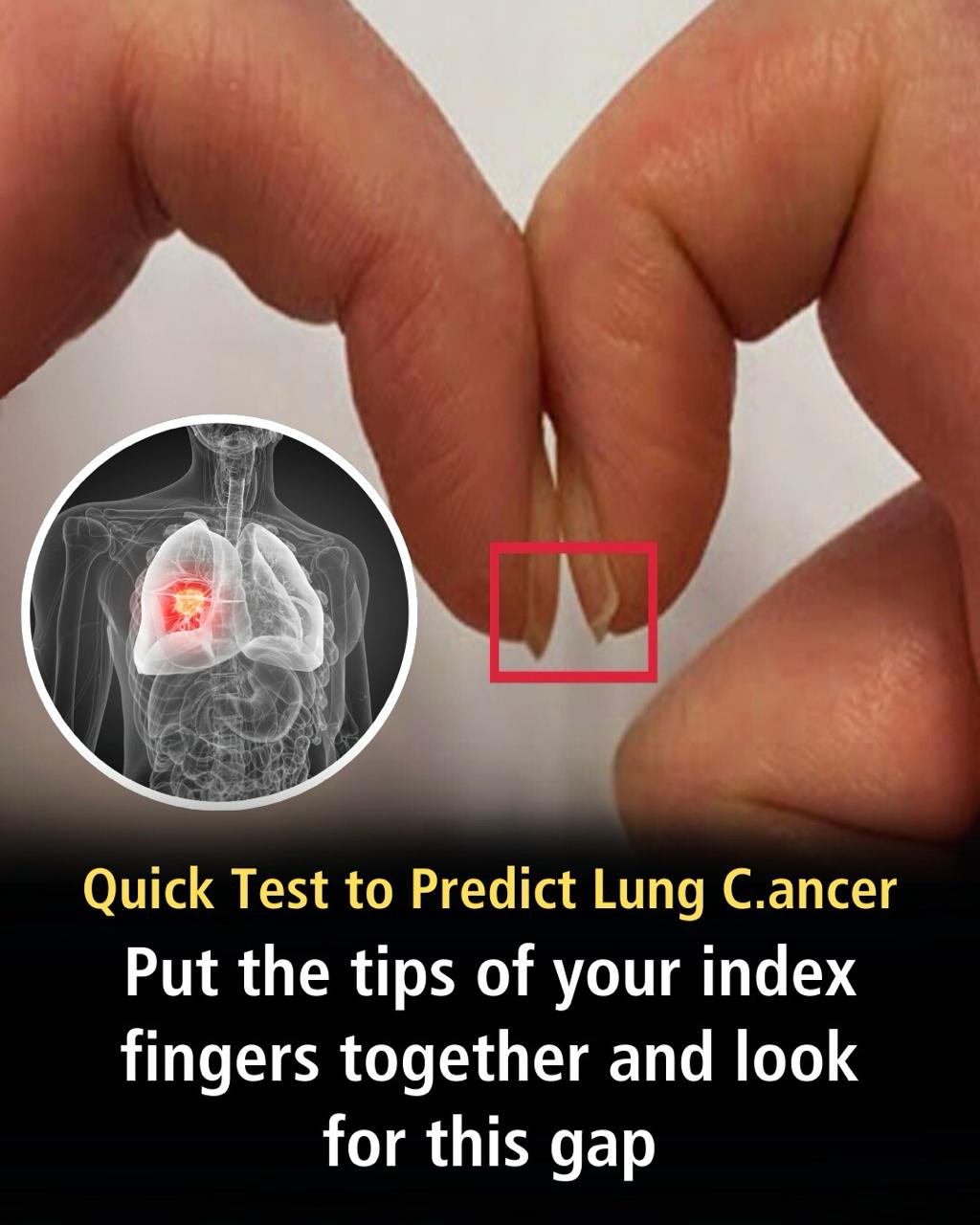 Title: This Simple Fingernail Test Could Help Detect Lung Cancer Early — And Potentially Save Your Life