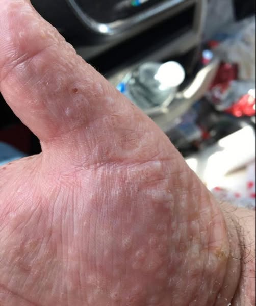 I went an pumped my gas at quick trip to fill my car up last night and woke up to these hard bumps.. what is it ?